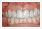 Dental Veneers - After 1