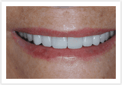 Dental Veneers - After 2