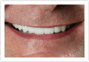 Dental Veneers - After 3