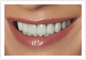 Dental Veneers - After 4