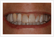 Dental Veneers - Before 2