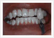 Teeth Whitening - After 1