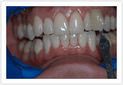 Teeth Whitening - Before 1