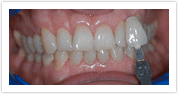 Teeth Whitening - Before 3