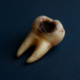 Severely decayed adult tooth that has fallen out, highlighting dental health neglect.